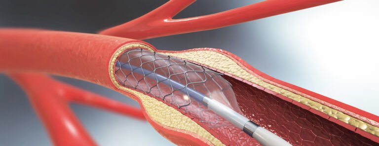 Coronary angioplasty in civil lines nagpur