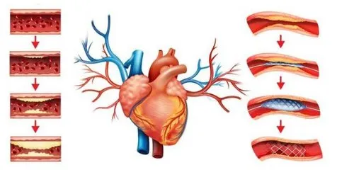 Coronary angioplasty in gandhibagh nagpur