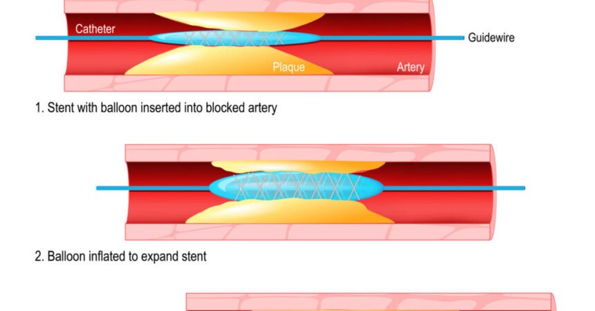 Coronary angioplasty in hingna road nagpur