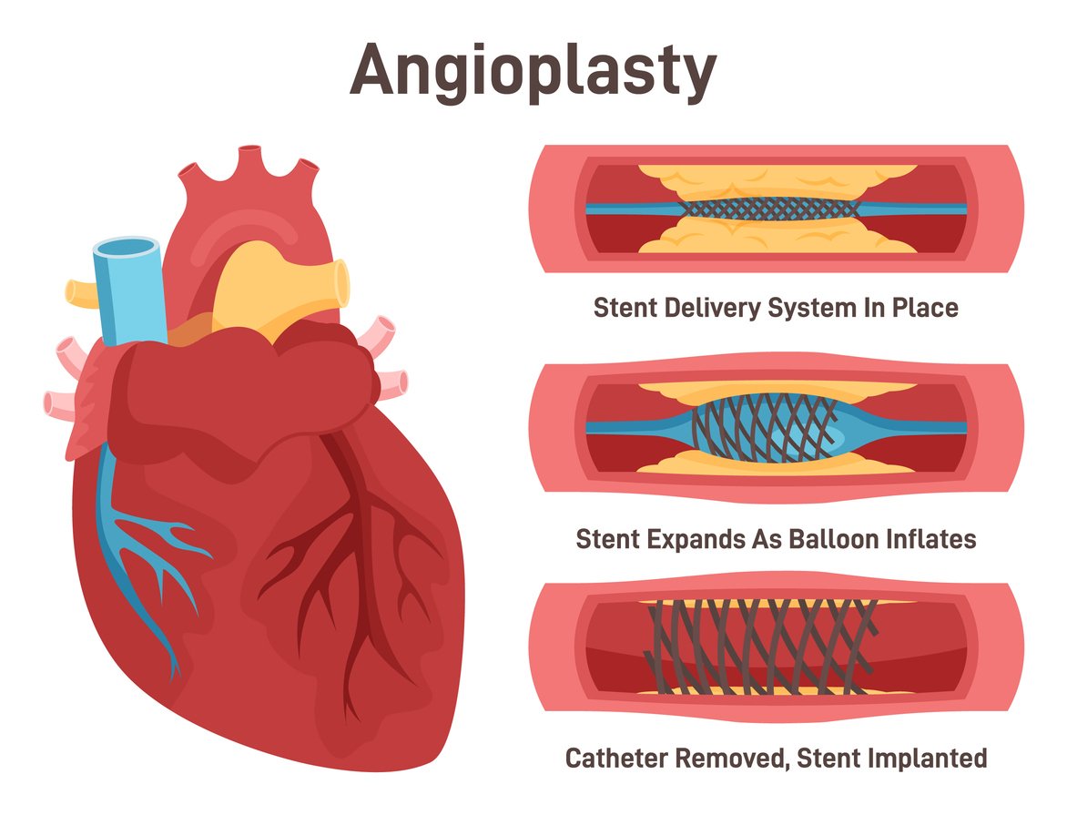 Coronary angioplasty in khare town nagpur