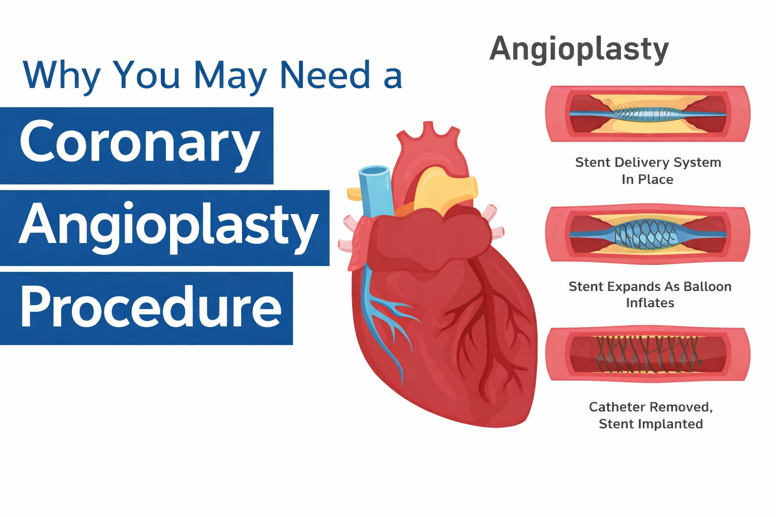 Coronary angioplasty in mangalwari nagpur