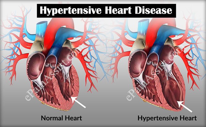 Hypertension heart specialist in jariptka nagpur