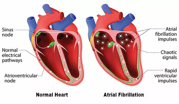 AFib Treatment in Nagpur