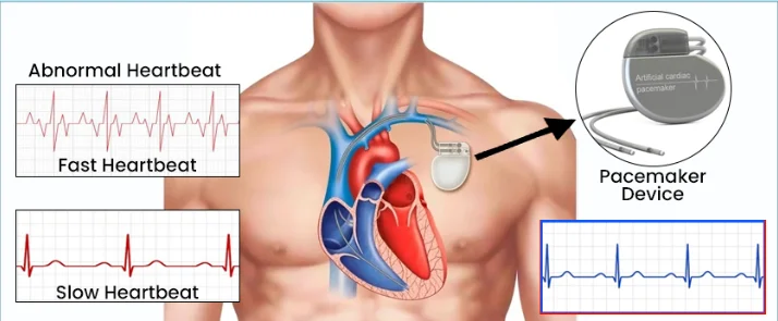 Heartbeat type explain in Pacemaker Implantation in Nagpur