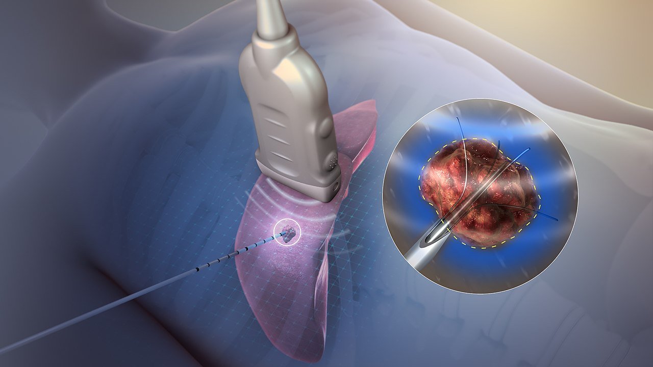 RF Ablation Specialist in Nagpur