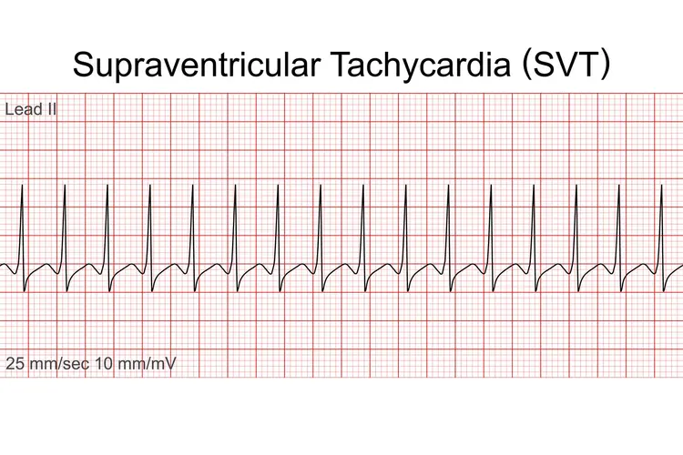 ECG Image for SVT Treatment in Nagpur